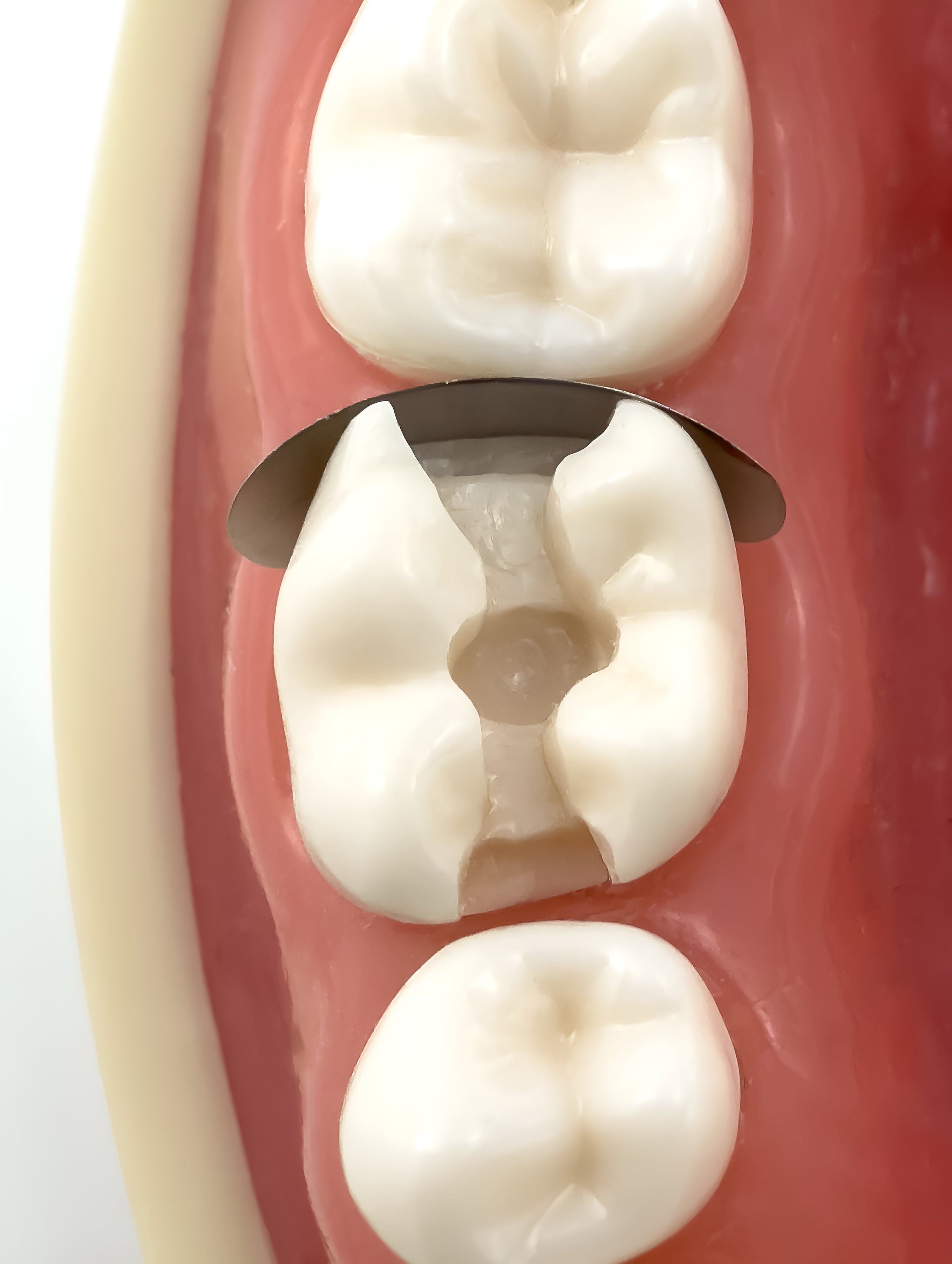 Medium Sectional Contoured Matrices 50pcs