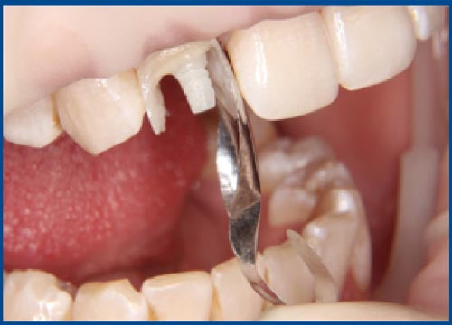 Matrices pour la restauration des dents antérieures (taille moyenne) - 12 pièces