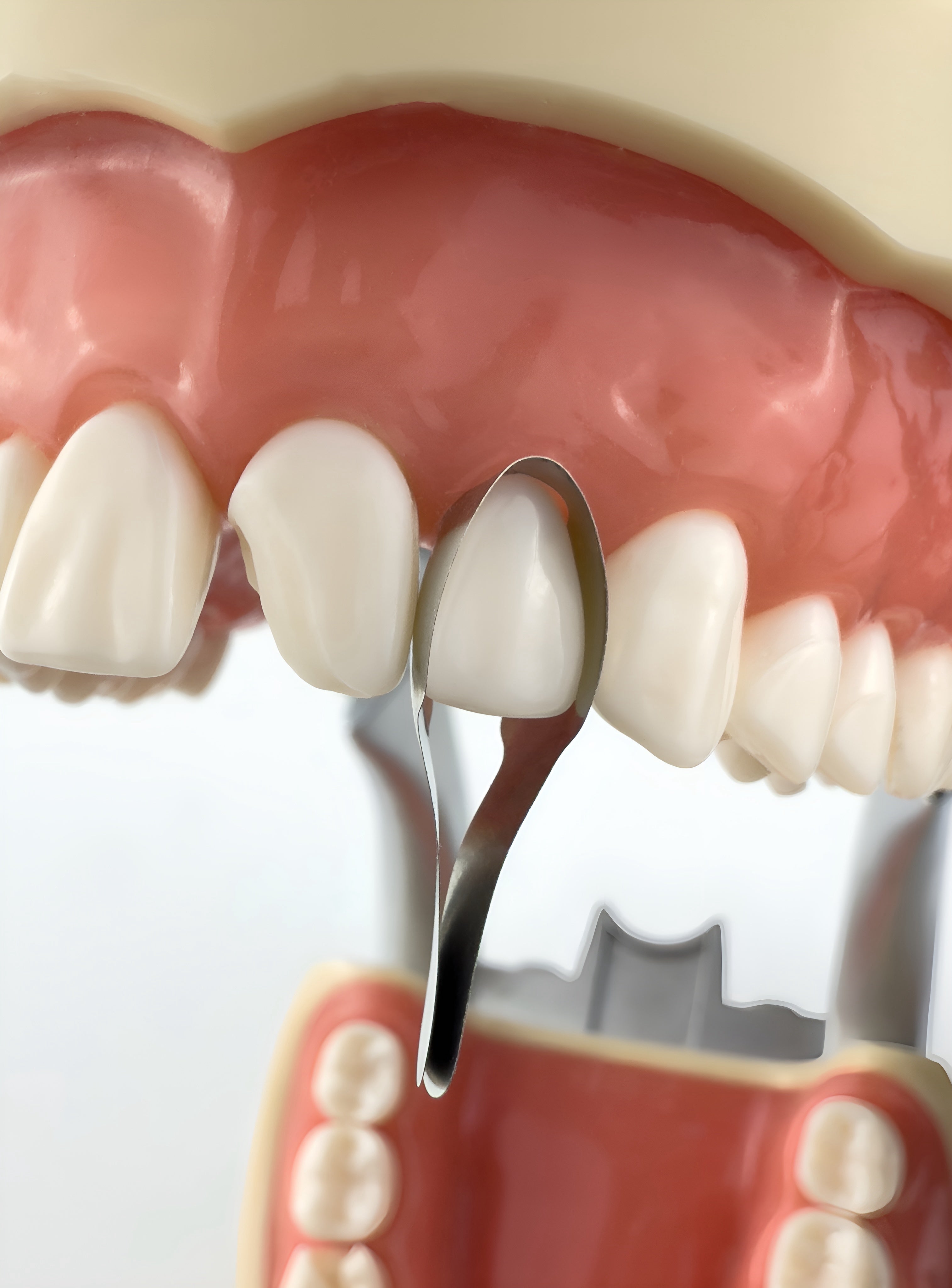 Matrices anteriores gemelas (incisales) 12 piezas
