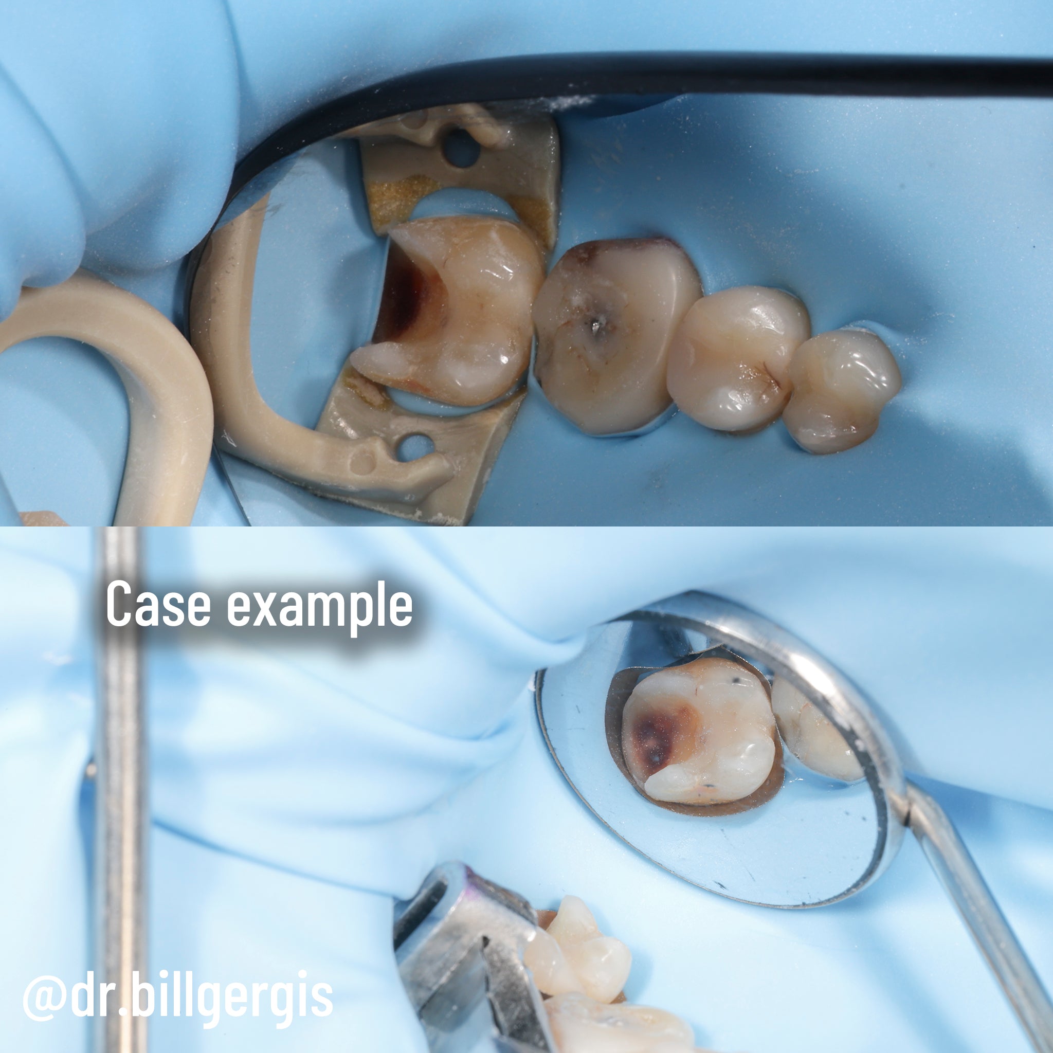 Matrice DME Gergis taille n° 2