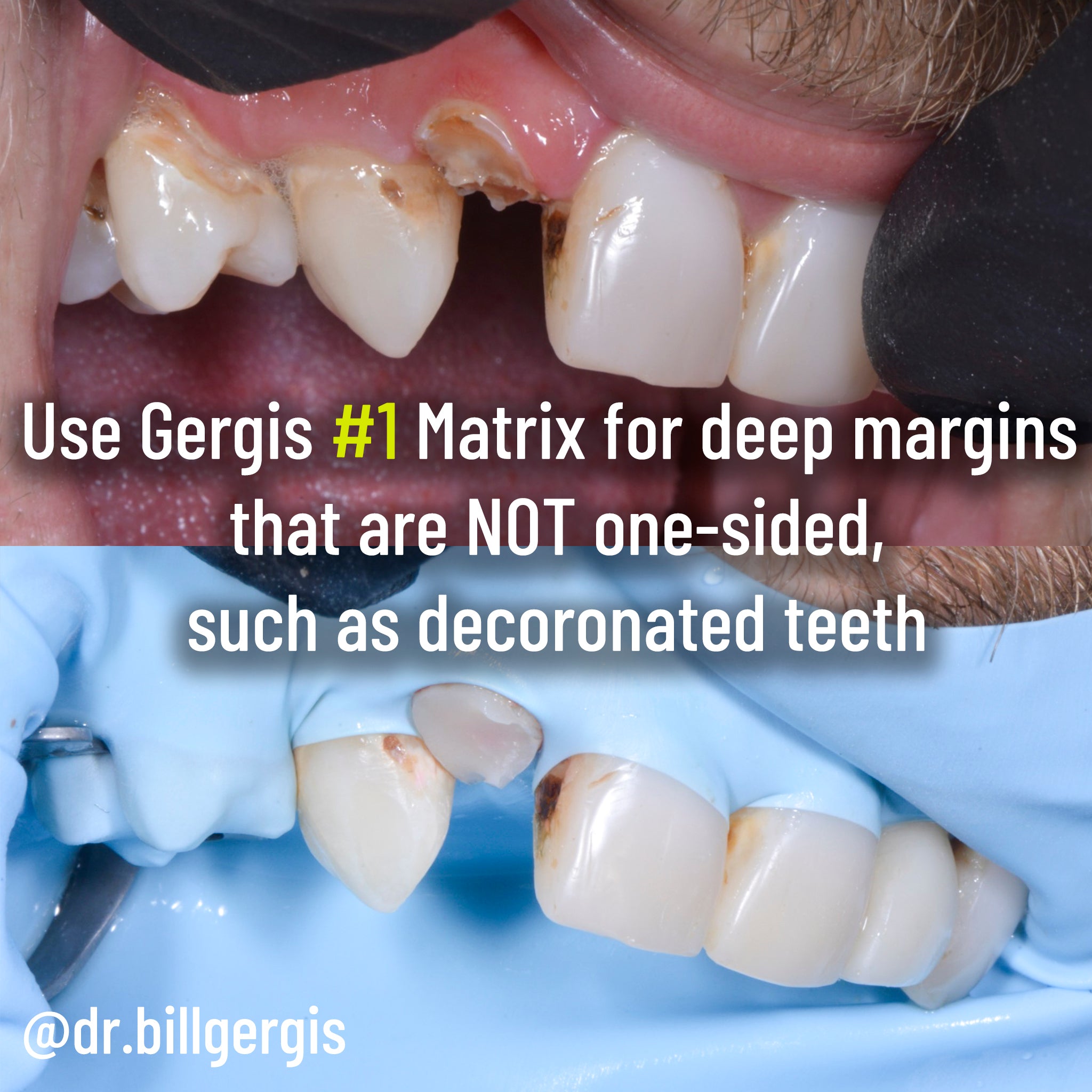 Matrice DME Gergis taille n° 2