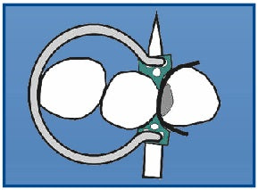 Kit de fixation Delta