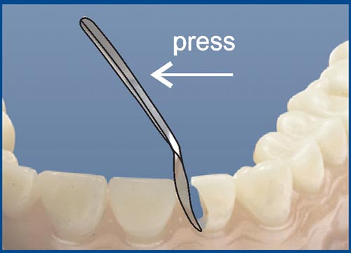 Matrices for front teeth restoration (medium) 12 pcs