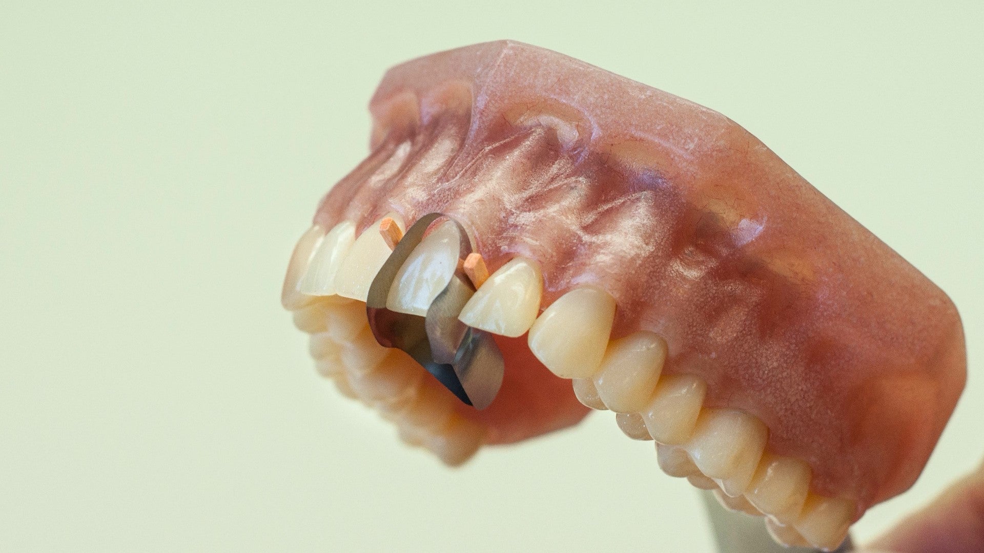 Matrices anteriores gemelas (palatinas) 12 piezas